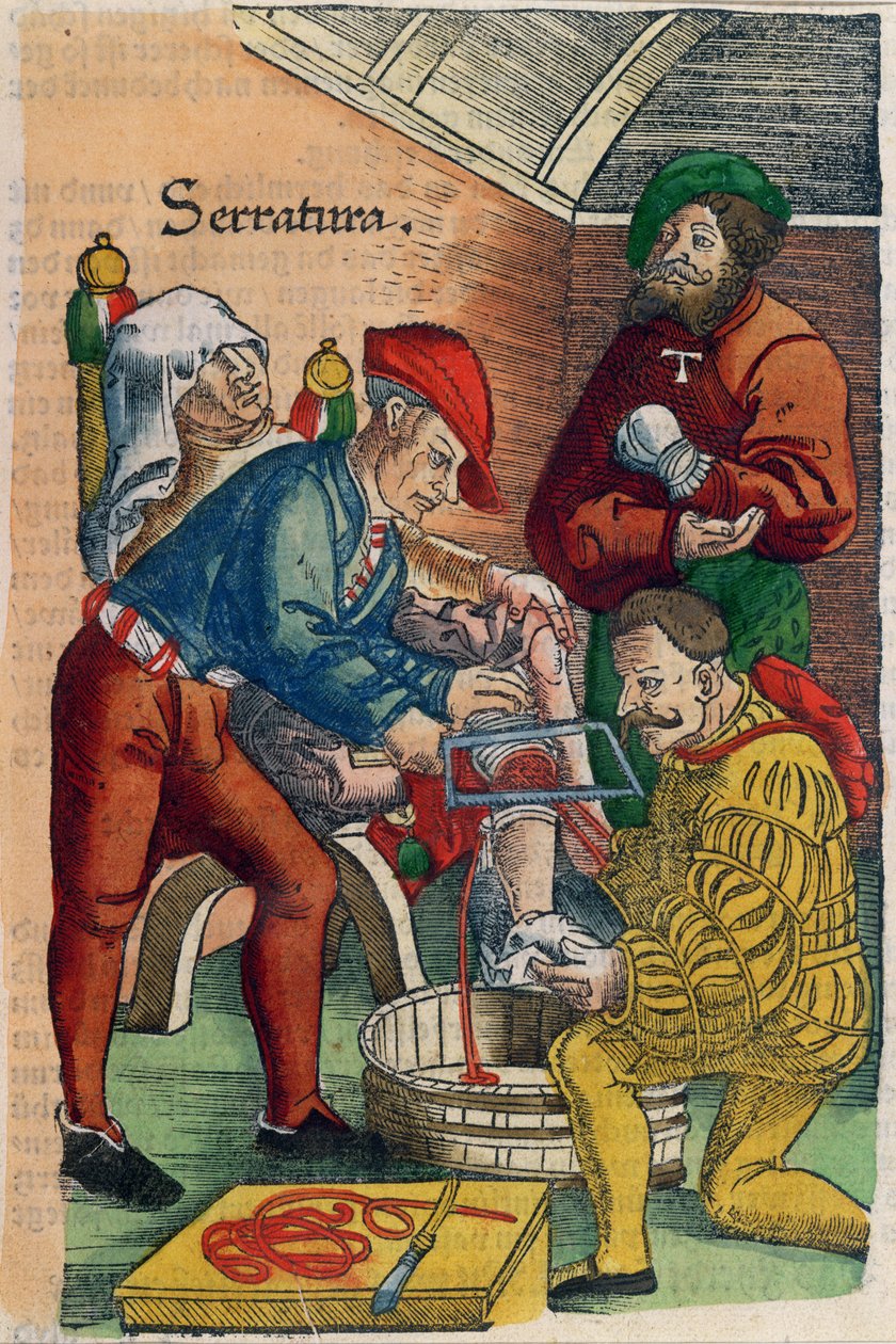 Amputace, ilustrace z 
