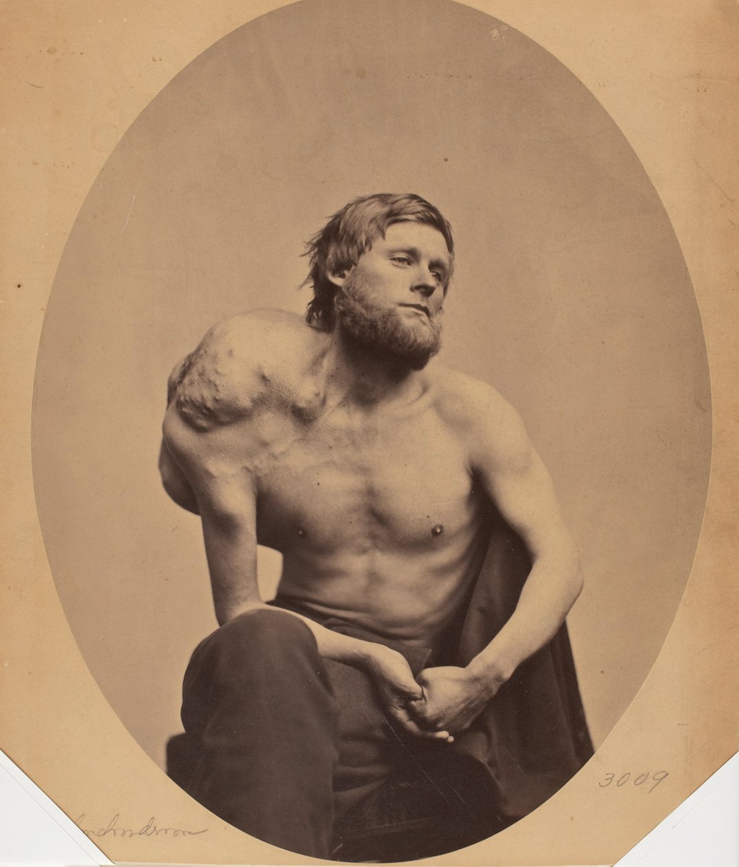 Enchondroma lopatky od James Wallace Black
