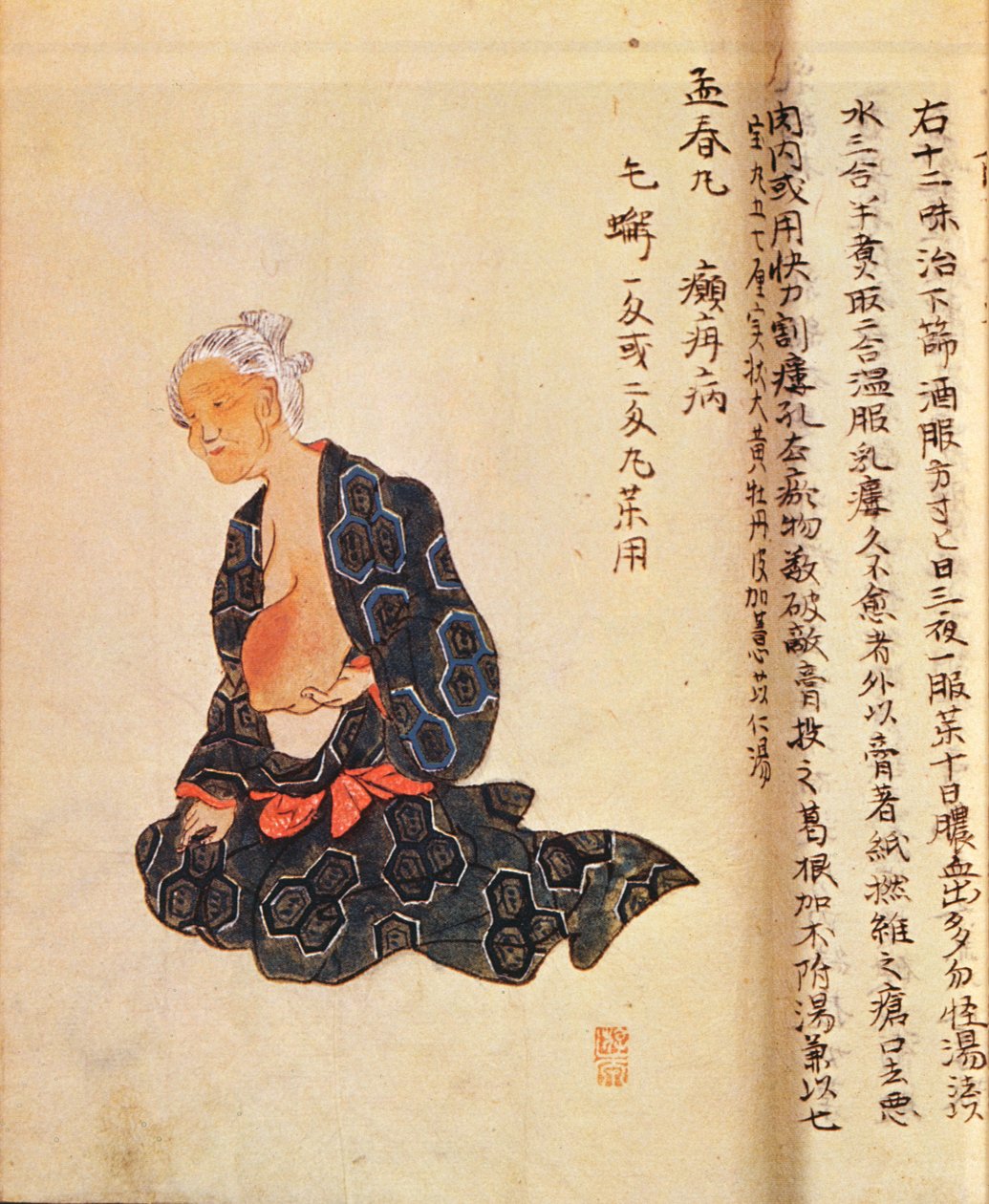 První chirurgická léčba rakoviny prsu, kterou provedl v celkové anestezii Seishu Hanaoka (1760-1836) v roce 1804 od Japanese School