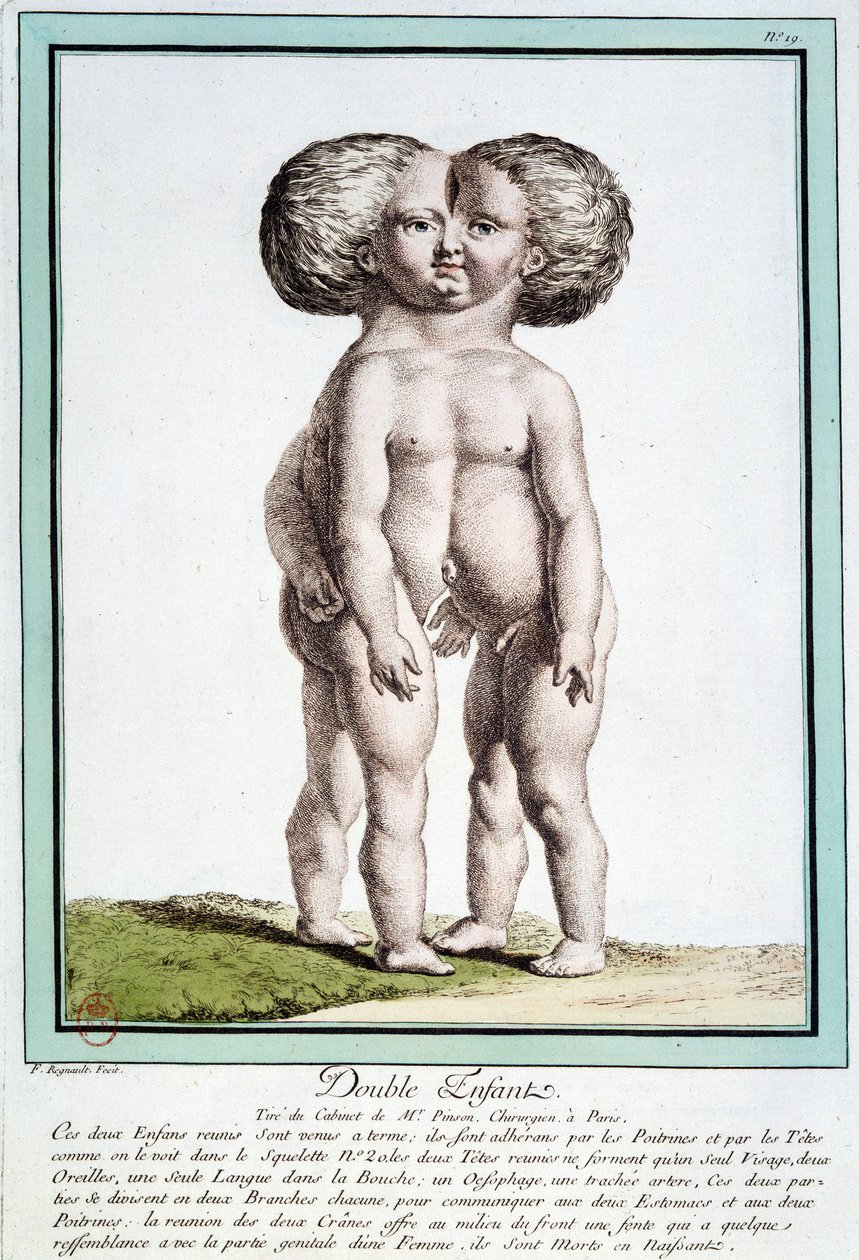Siamské děti - v „“Odchylky přírody““ od Régnaulta od Jean Baptiste Regnault