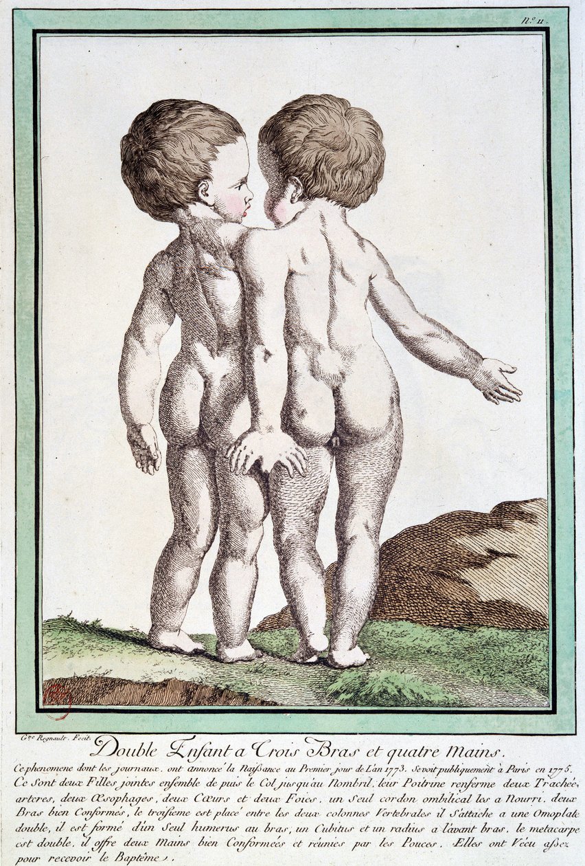 Siamské děti - v „“Les divisions de la nature““ od Régnaulta od Jean Baptiste Regnault