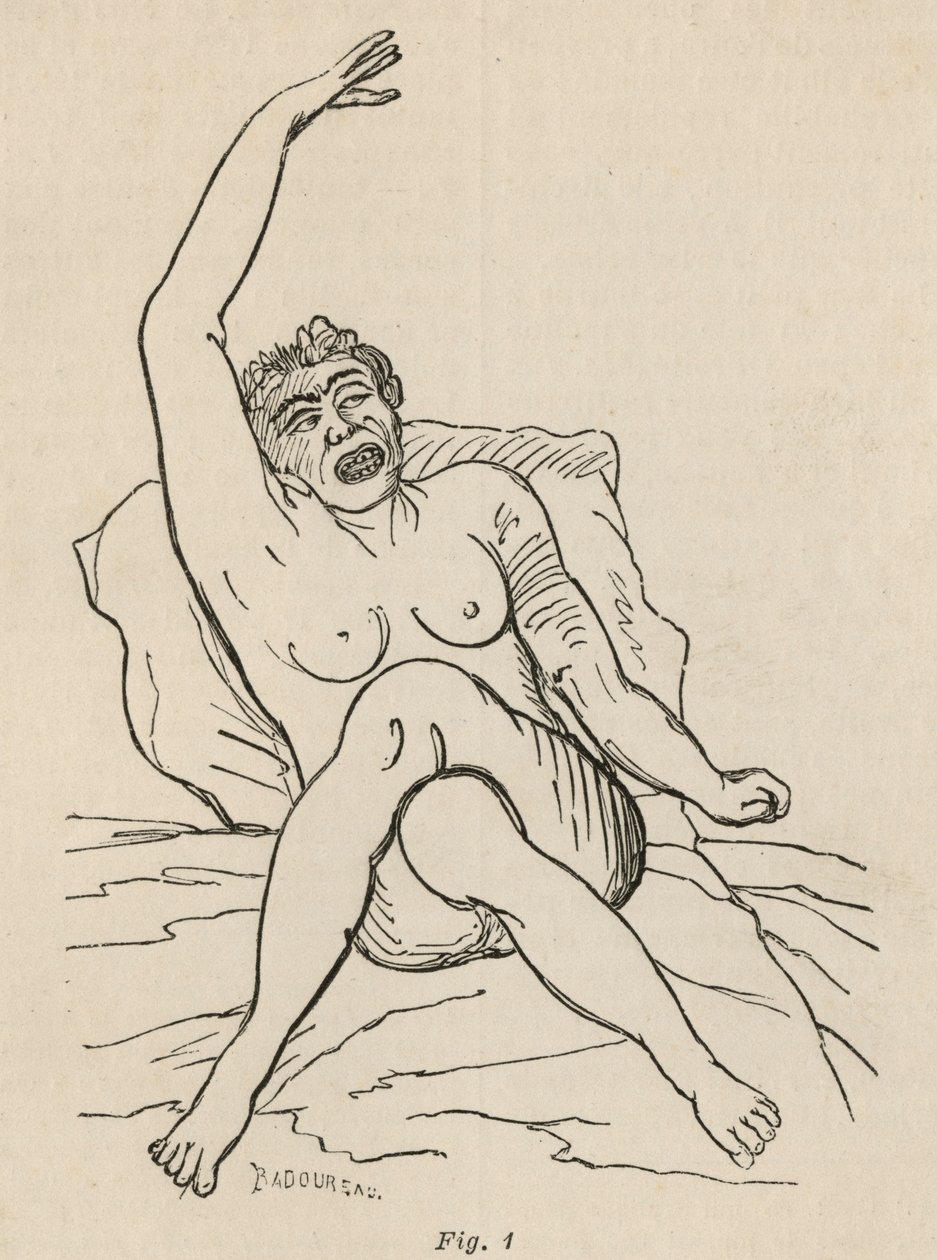 Hysterická epilepsie, záchvat, zkroucení, obr. 1 z „Iconographie Photographique de La Salpetriere“ od Bourneville et P. Regnard, Paříž, 1876 od Jean Francois Badoureau