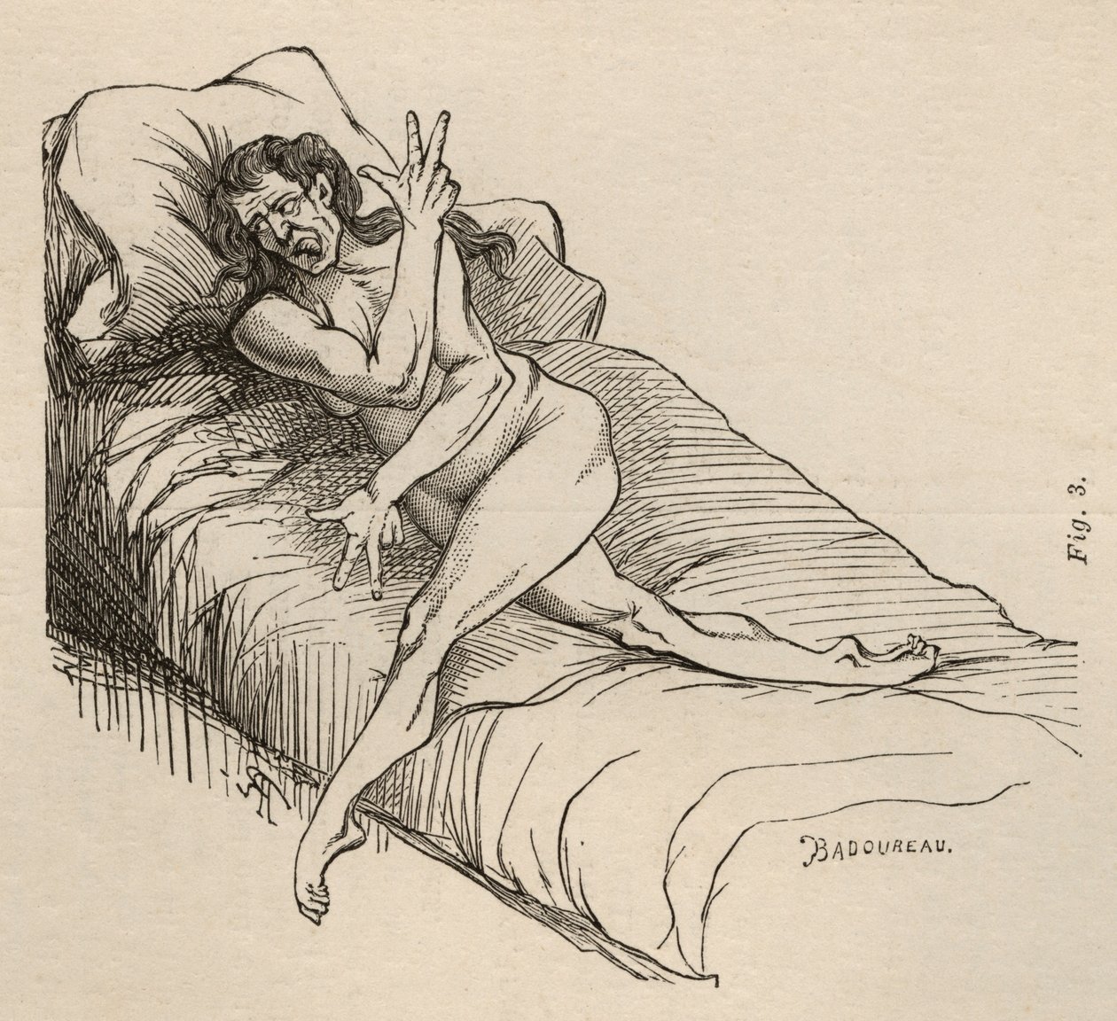 Hysterická epilepsie, záchvat, zkroucení, obr. 3 z „Iconographie Photographique de La Salpetriere“ od Bourneville et P. Regnard, Paříž, 1876 od Jean Francois Badoureau