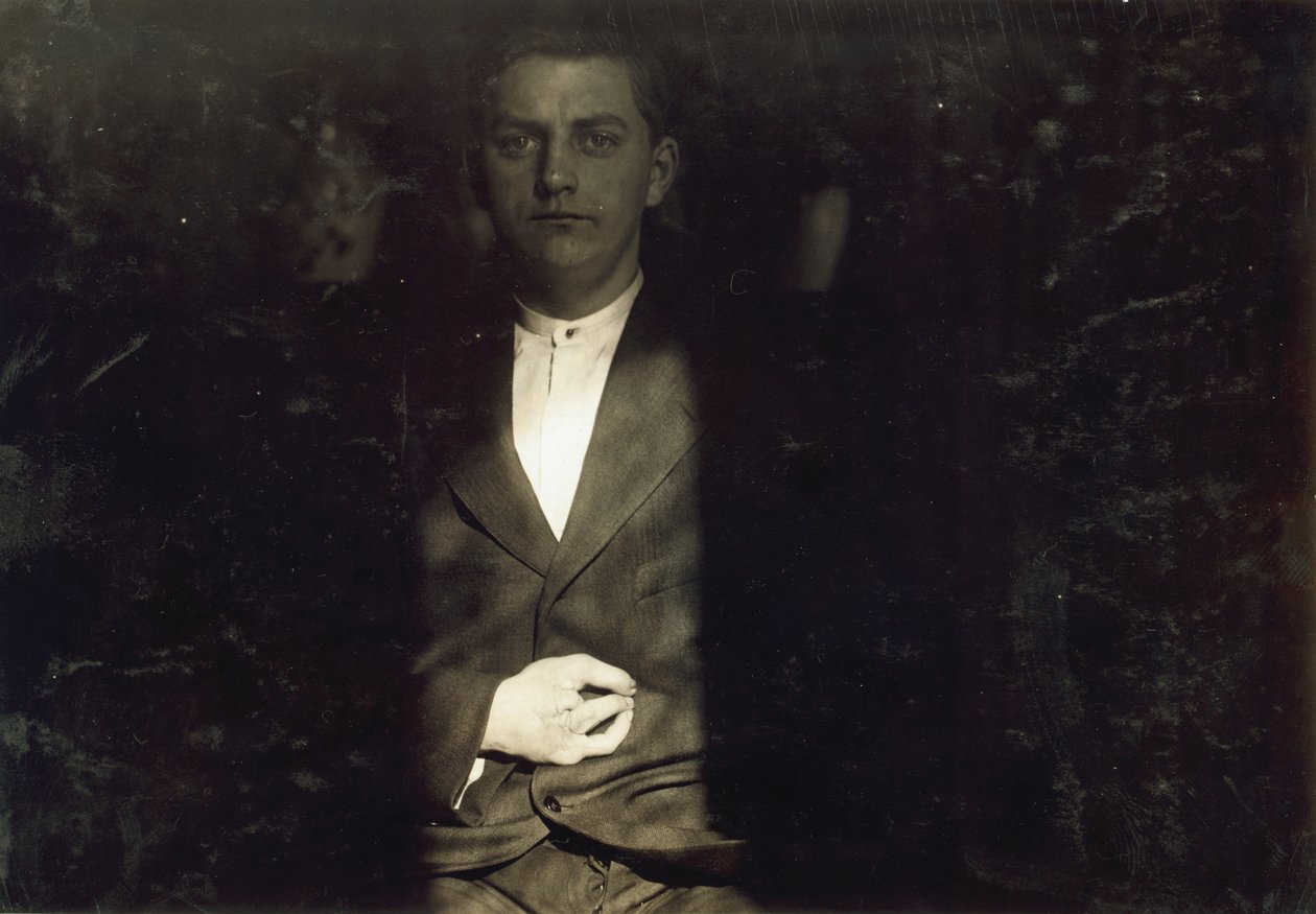 Frank Wiegel z Brooklynu, zraněný po 18 hodinách práce denně v 15 letech, dva prsty na pravé ruce mu byly amputovány, New York city od Lewis Wickes Hine