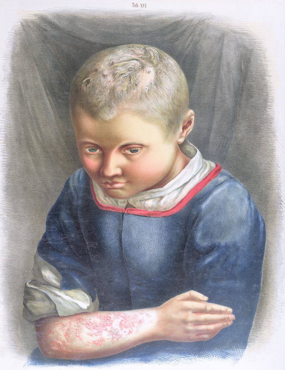 Favus, z knihy Daniela Corneliuse Danielssena (1815-94) 1892 od Norwegian School