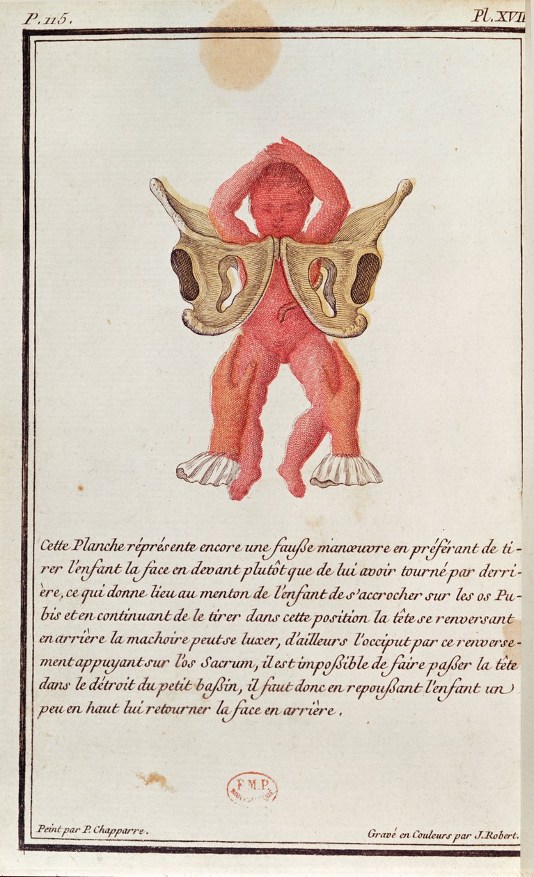 Průřezový diagram dítěte vytaženého z lůna za nohy, z knihy Madame Angelique Le Boursier du Coudray (1714-94) vyryté J. Robertem, 1783 od P. Chapparre