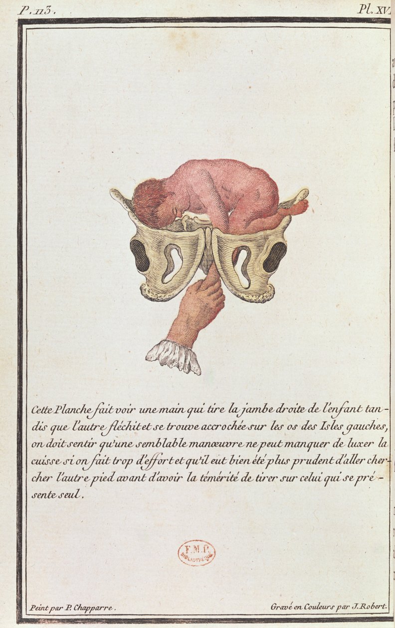Průřezový diagram dítěte vytaženého z lůna za paži, z knihy Madame Angelique Le Boursier du Coudray (1714-94), kterou vyryl J. Robert, 1783 od P. Chapparre