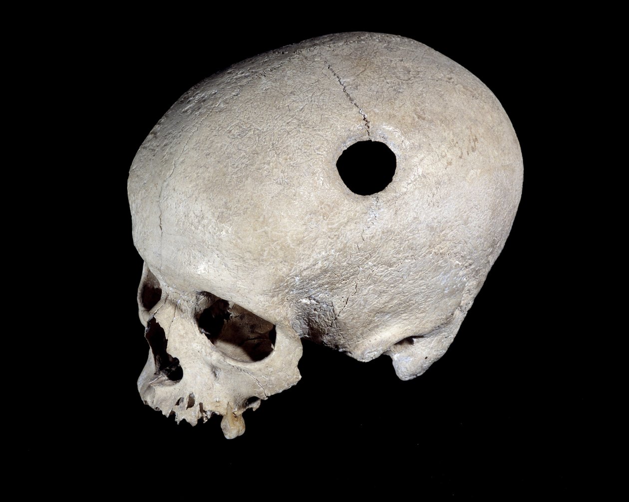 Pravěká lebka s trepanační stopou, Muzeum národních starožitností. od Prehistoric Prehistoric