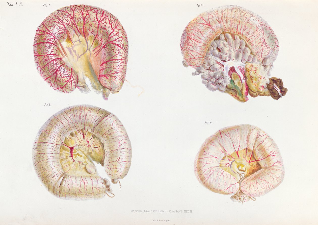Vnější povrch střev infikovaných cholerou, z Anatomie Pathologique du Cholera Morbus, od Nikolaje Ivanoviče Pirogova (1810-81), publikováno v Petrohradě, 1849 od Russian School
