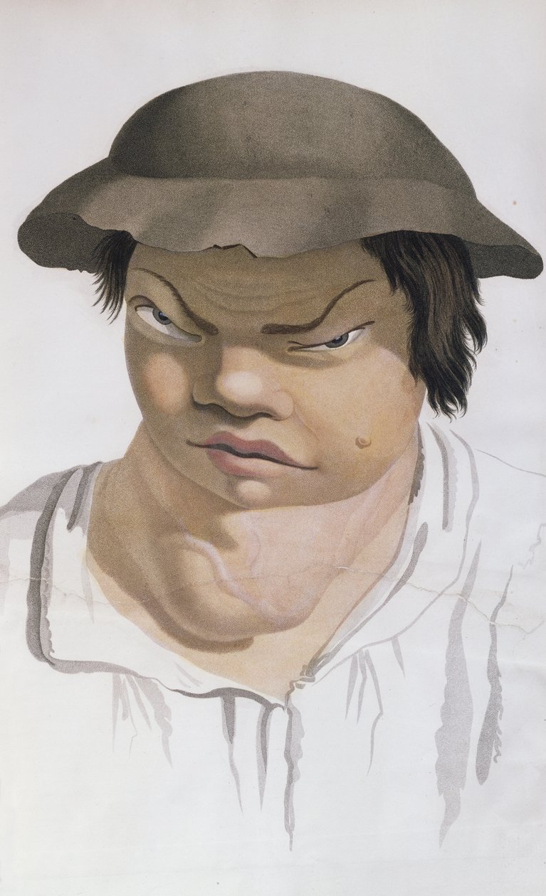 Endemic Scrofula, ilustrace z knihy barona Jean Louis Alibert (1768-1837) od Salvadore Tresca