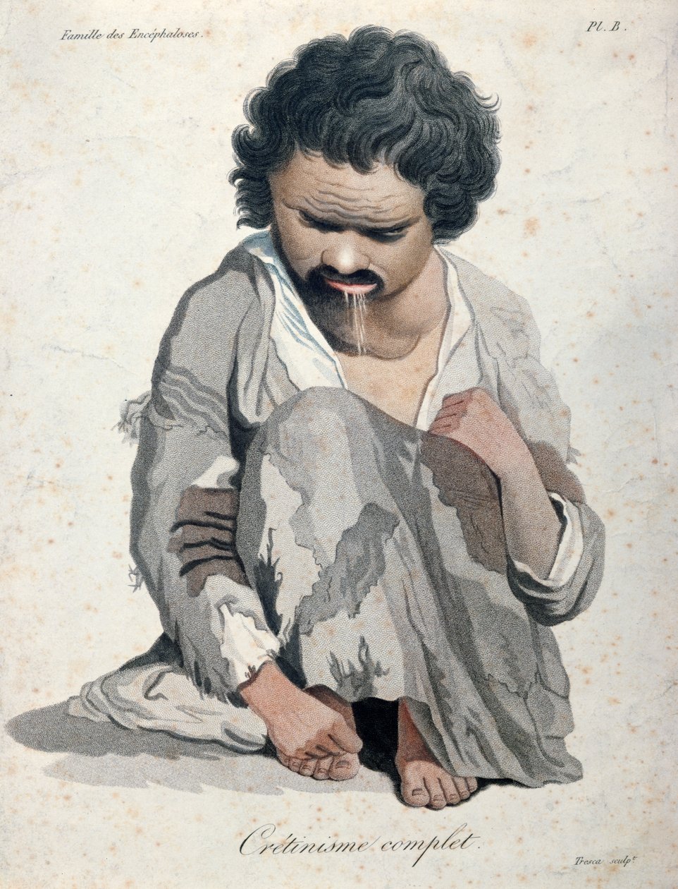 Totální kretinismus, z knihy barona Jean Louis Alibert (1768-1837) od Salvadore Tresca