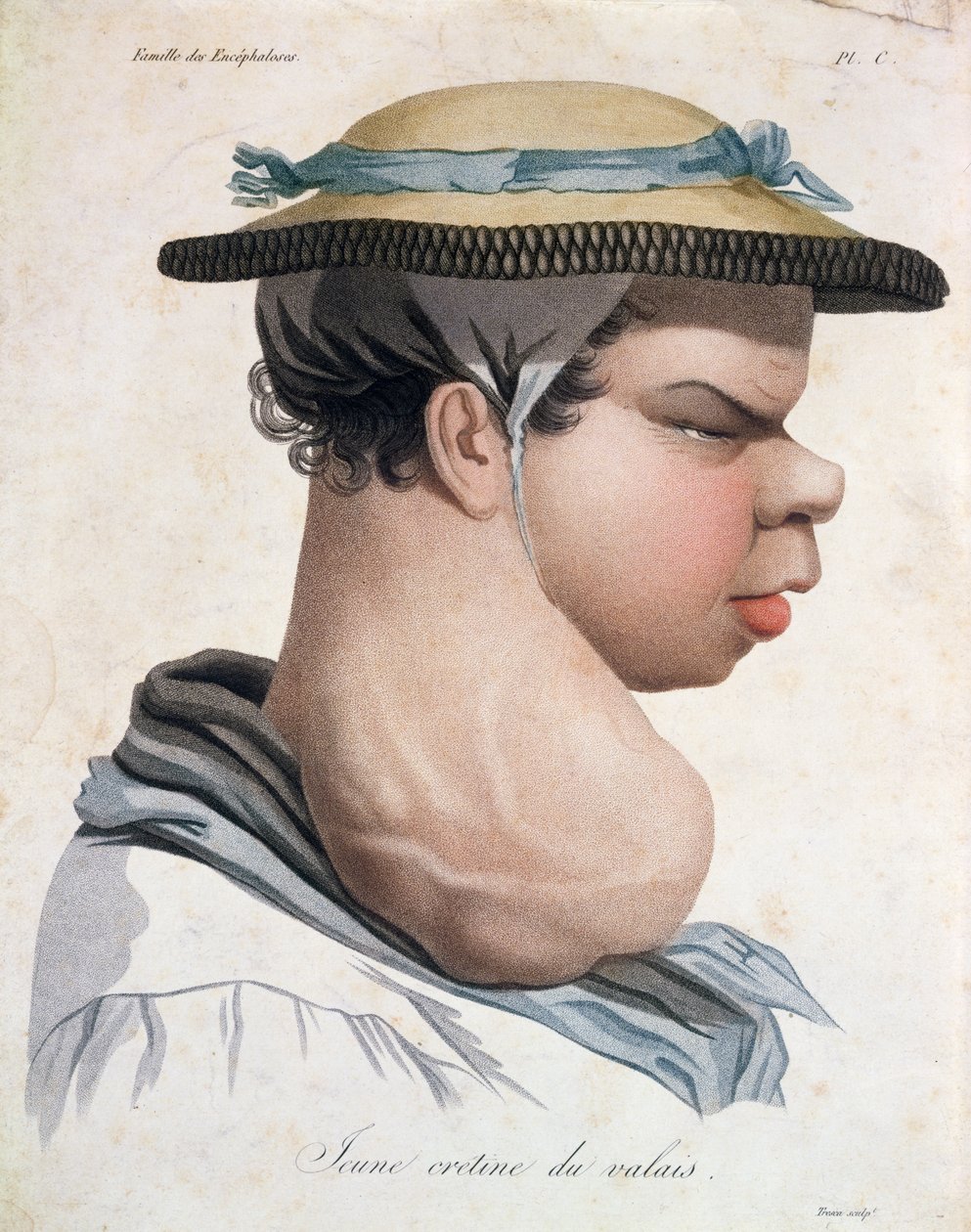 Mladý Cretin z Valais, ilustrace z knihy barona Jean Louis Alibert (1768-1837) od Salvadore Tresca