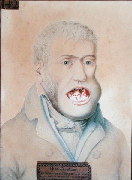 Osteosarkom dolní čelisti, úspěšně operovaný Guillaume Dupuytrenem (1777-1835) (tužka na papíře) od School French