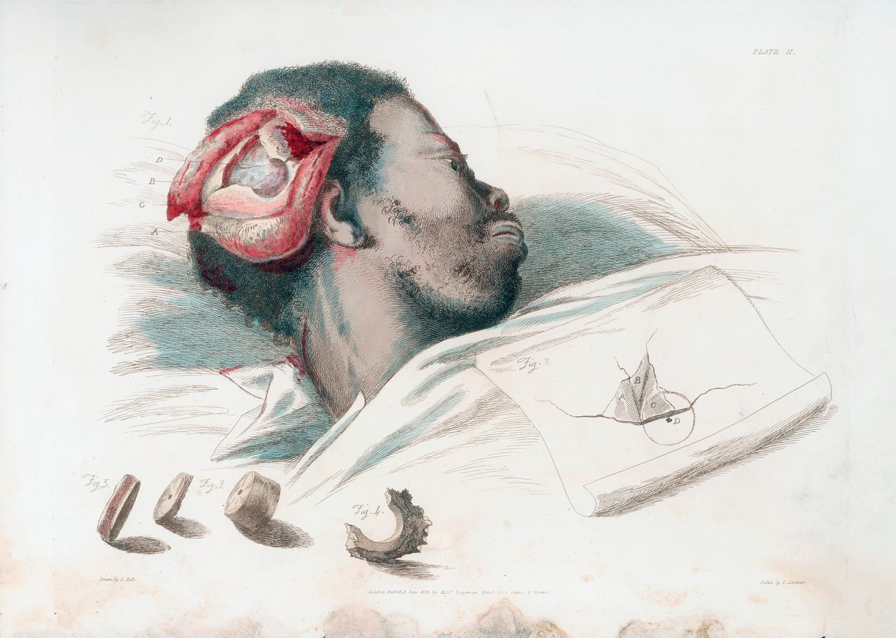 Pohled na ránu v lebce po trefinaci a odstranění roztříštěného kusu kosti vlevo dole, 1821 od Thomas Landseer