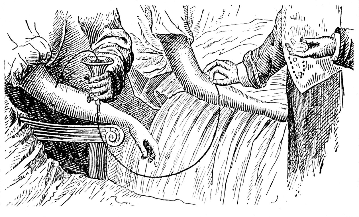 Krevní transfuze, c1880 od Unbekannt