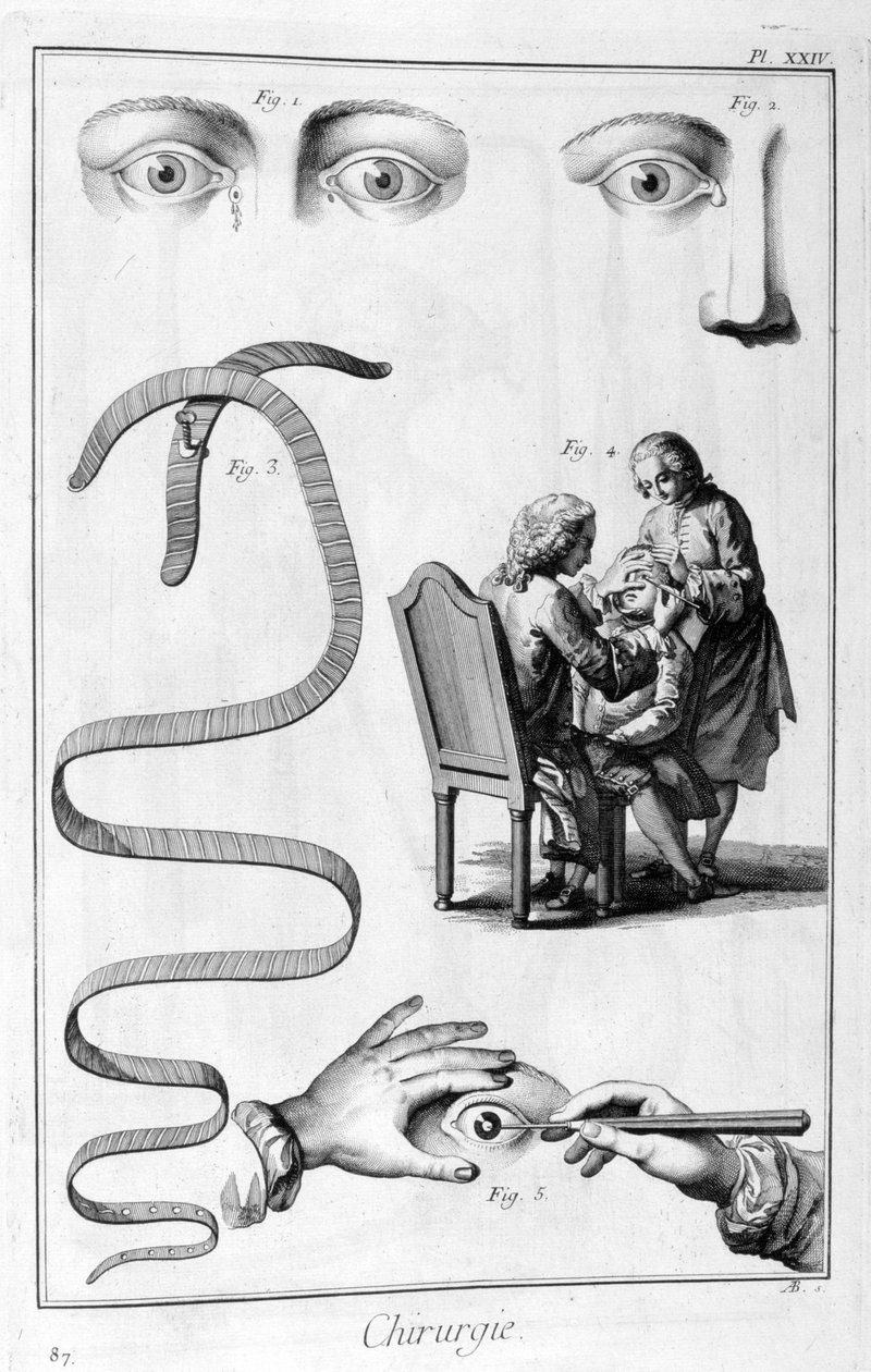 Oční chirurgie, 1751-1777 od Unbekannt