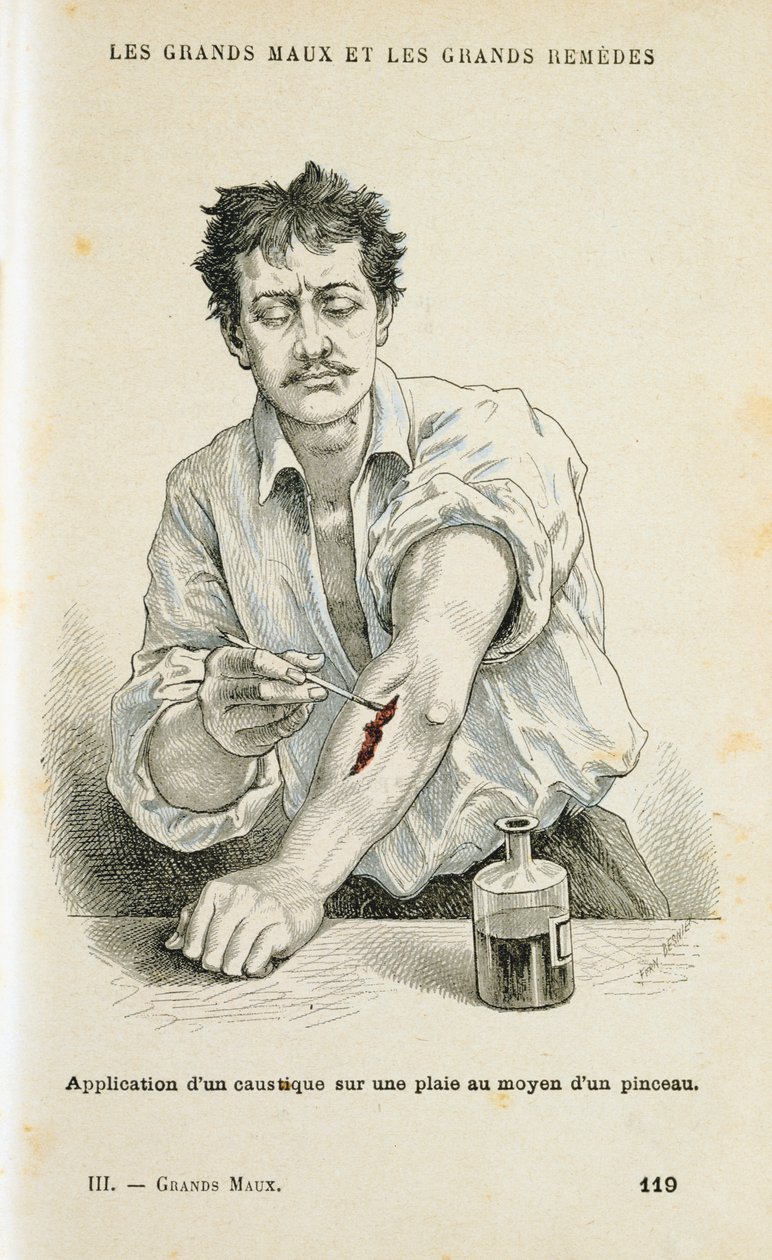 Natírání rány antiseptickým roztokem, c1890 od Unbekannt