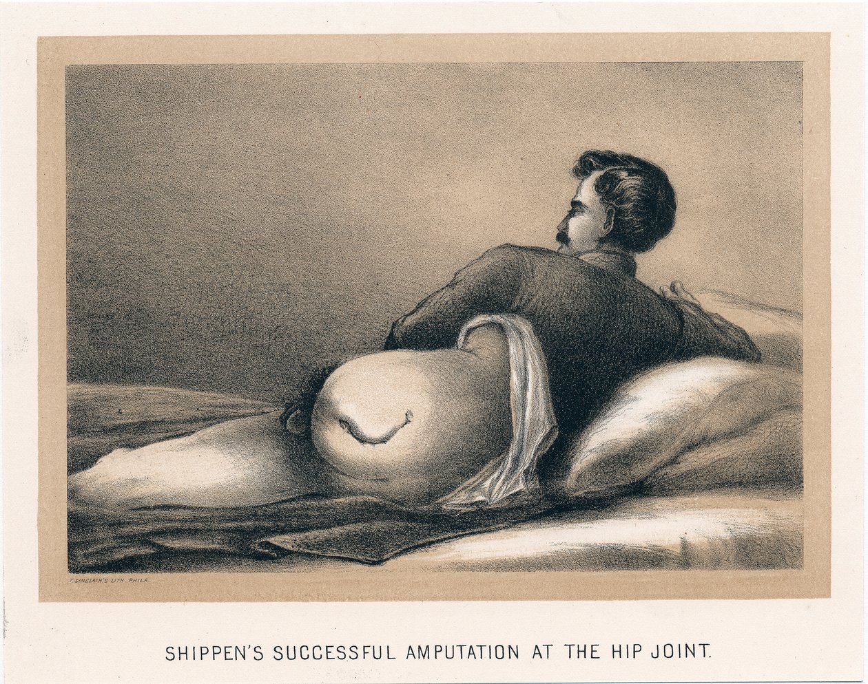 Shippens úspěšná amputace v kyčelním kloubu, Americká občanská válka, 1865 od Unbekannt