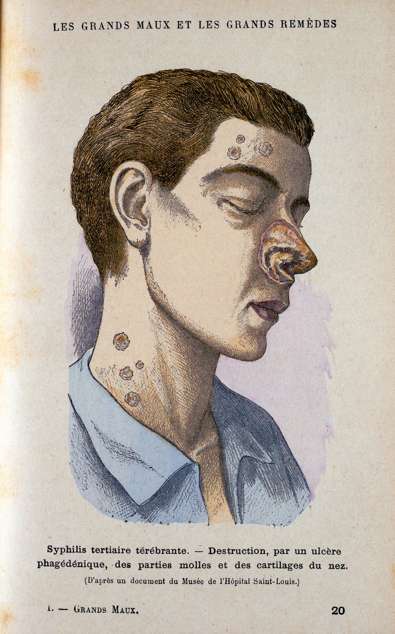 Příznaky terciární fáze syfilis, c19. století od Unbekannt