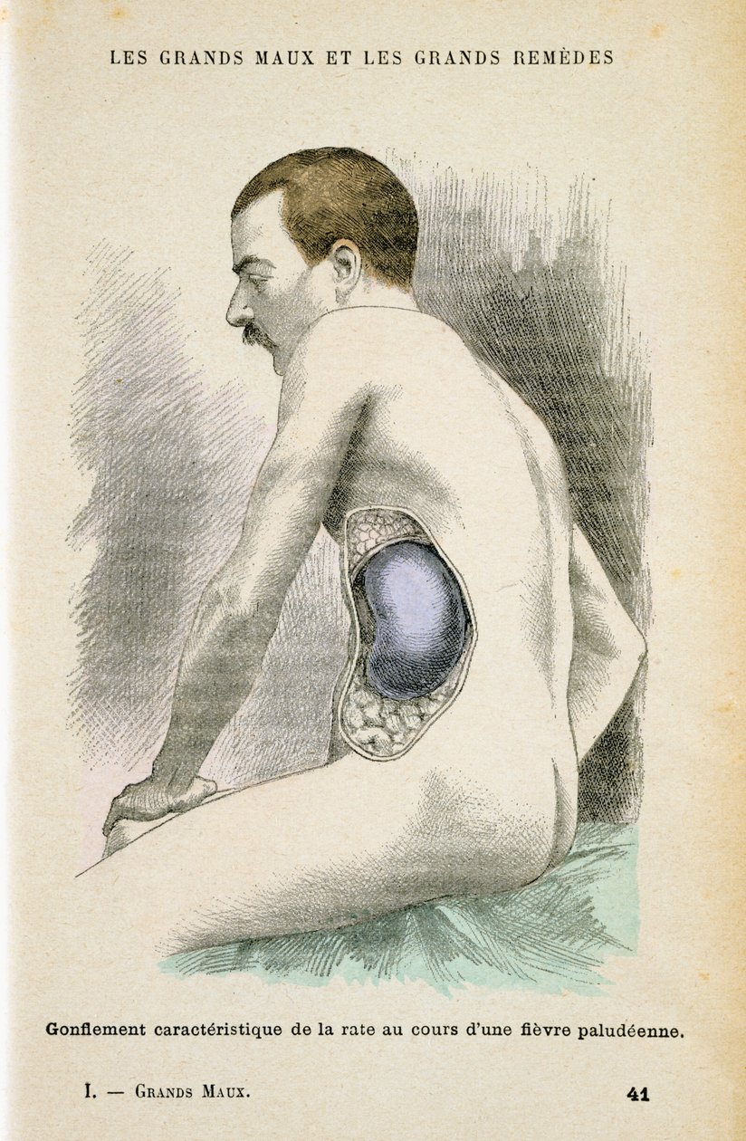 Typická zvětšená slezina pacienta s malárií, c1890 od Unbekannt