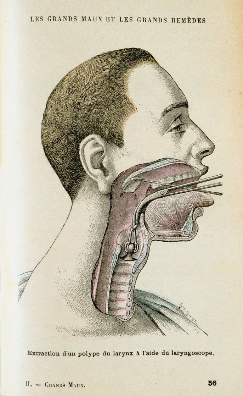 Použití laryngoskopu k odstranění polypu z krku, c1890 od Unbekannt