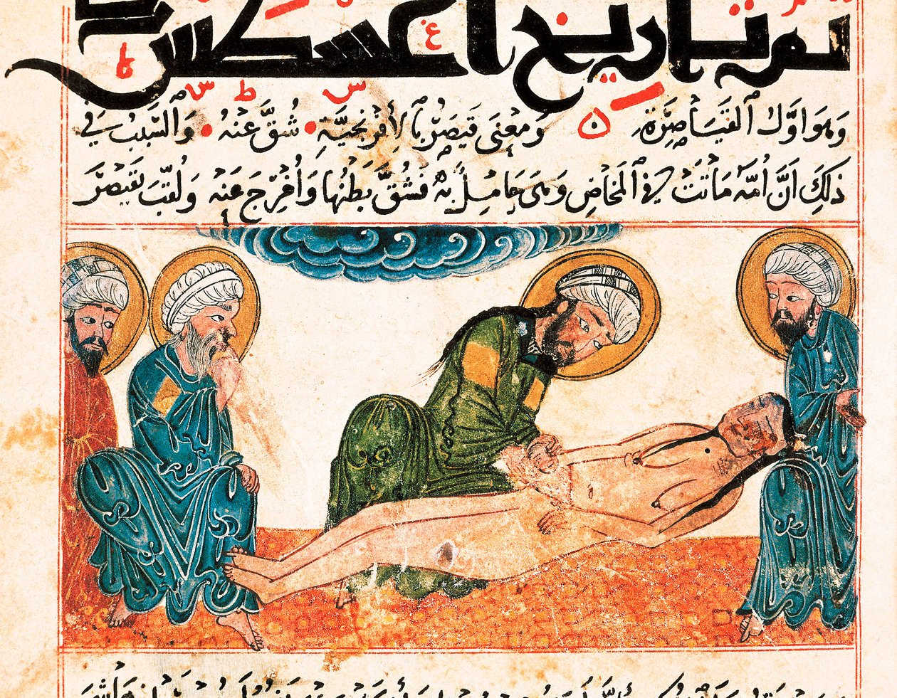 Reprezentace porodu císařským řezem. Miniatura převzatá z rukopisu medicíny Abu Raihan Al-Biruni (nebo Alberuni) (973-1048), perský intelektuál a vědec, folio 161. od Unbekannt