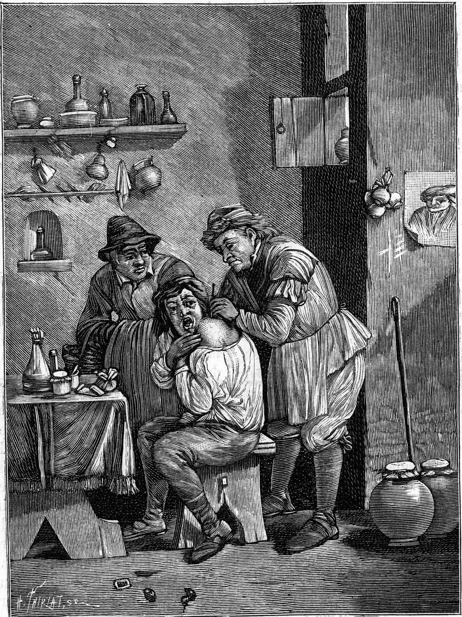 Šarlatánský chirurg v 18. století vyšetřující zranění ramene. (Z rytiny času). Gravírování v „“ La Nature: revue des sciences et de leurs applications aux arts et a l