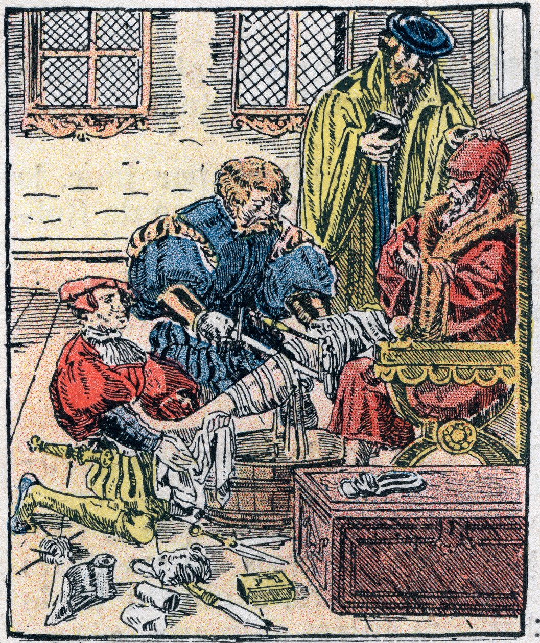 Amputace nohy v 16. století. od Unknown artist