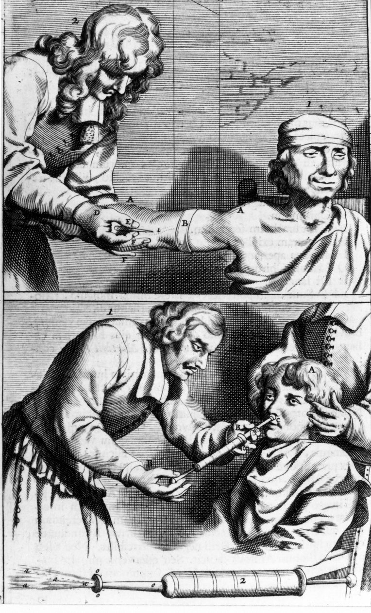 Krvácení a nosní sprcha od Johannese Sculptetiho “” Armamentarium Surgery”” Amsterdam 1672 od Unknown artist