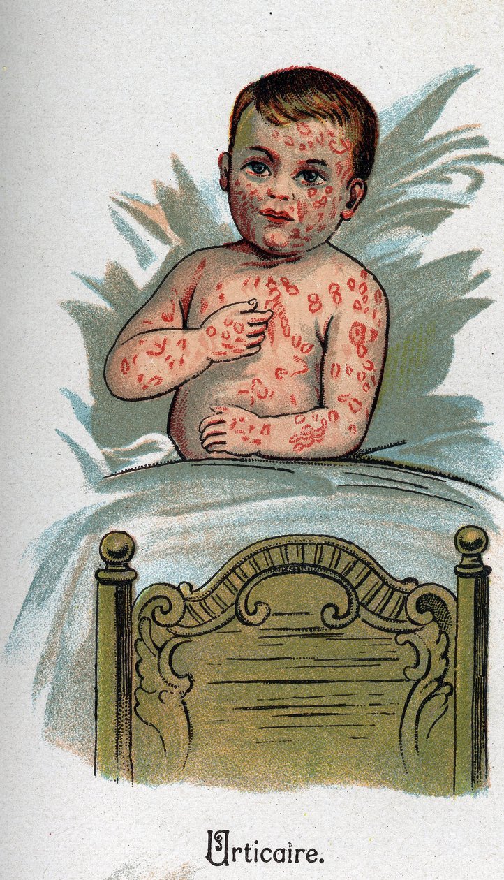 Dětské nemoci: Kopřivka. In „Nová přírodní medicína“ od F.E. Bilze. od Unknown artist