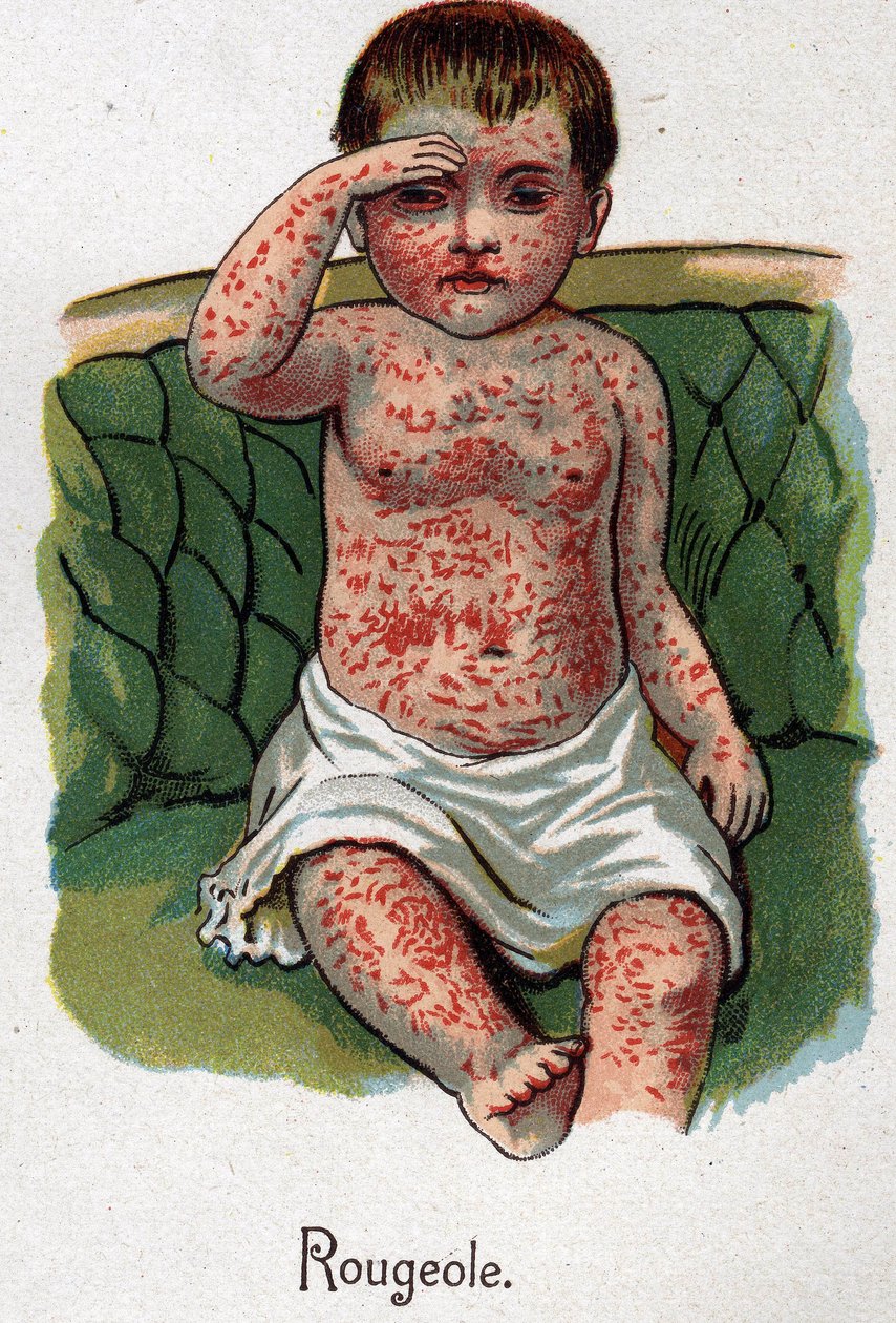 Dětské nemoci: Spalničky. In „Nová přírodní medicína“ od F.E. Bilze. od Unknown artist