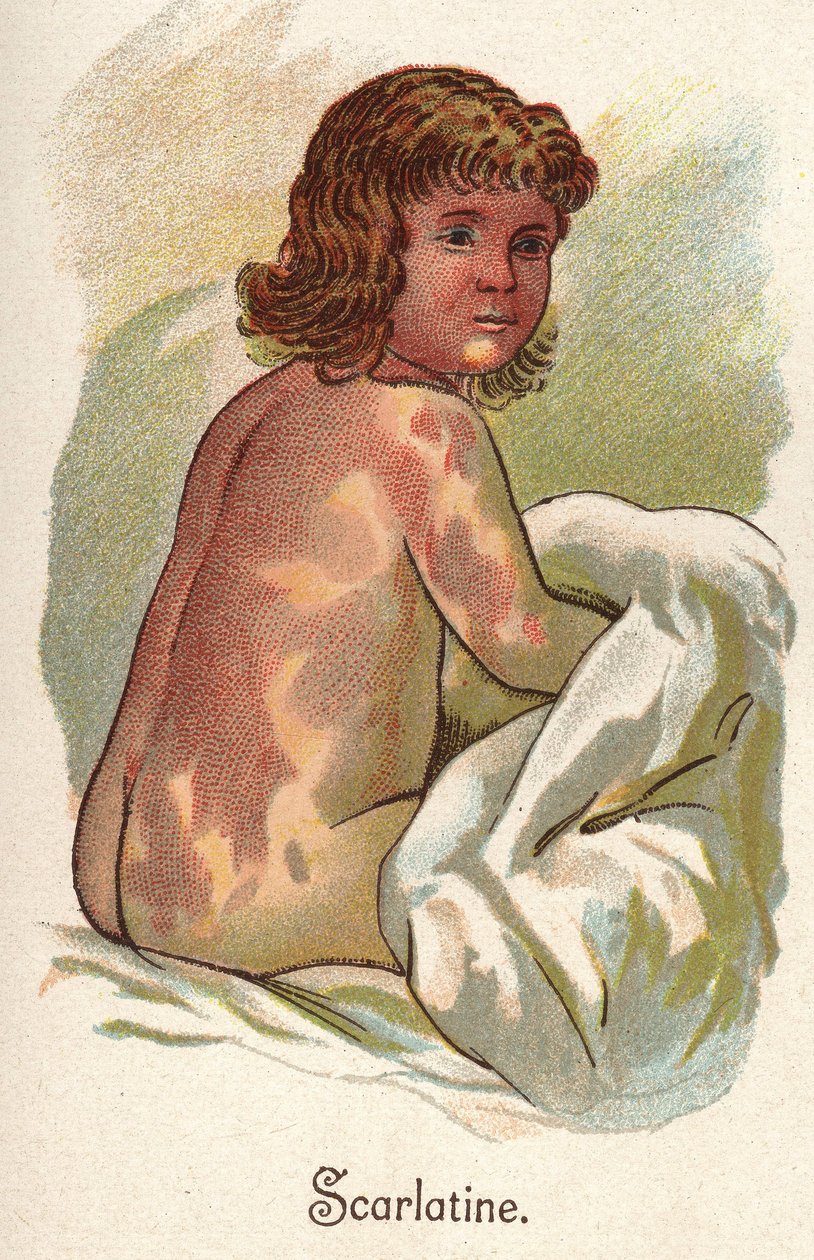 Dětské nemoci: Spála. In „Nová přírodní léčba“ od F.E. Bilze. od Unknown artist