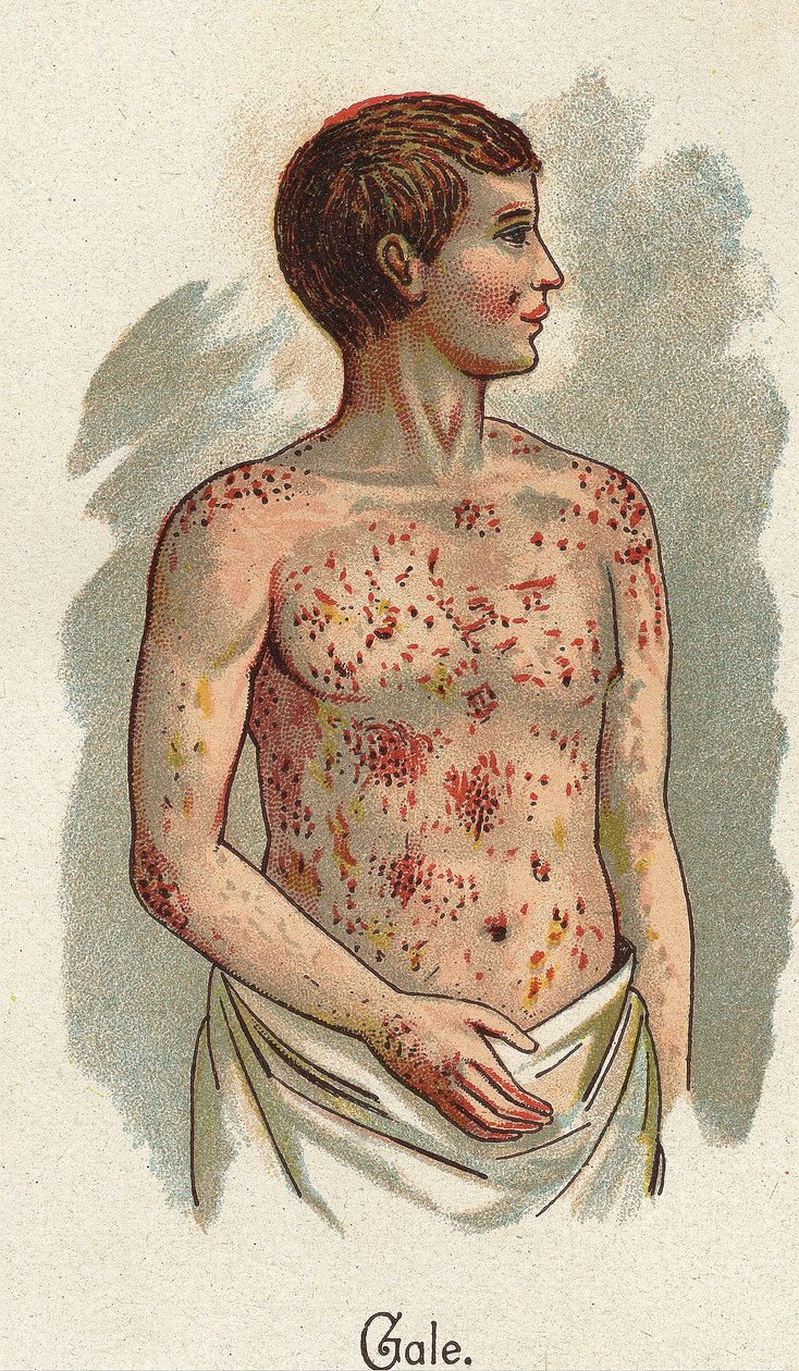 Dětské nemoci: Svrab. In „Nová přírodní léčba“ od F.E. Bilze. od Unknown artist