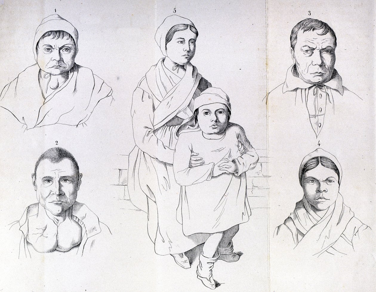 Úvahy o příčinách endemického kretinismu od Morela. od Unknown artist