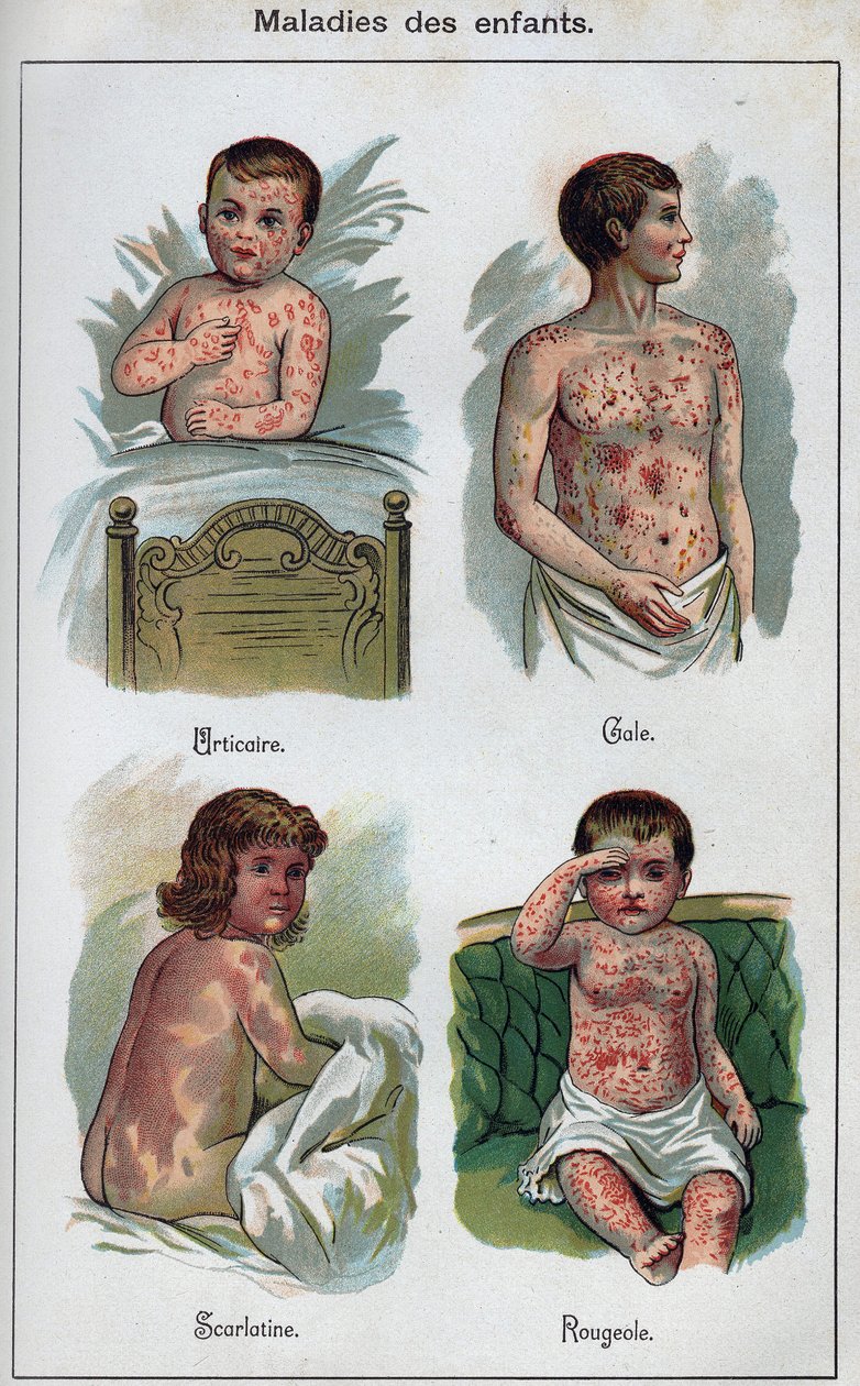 Nemoci dětí: Kopřivka, spalničky, svrab, spála. In „Nová přírodní léčba“ od F.E. Bilze. od Unknown artist