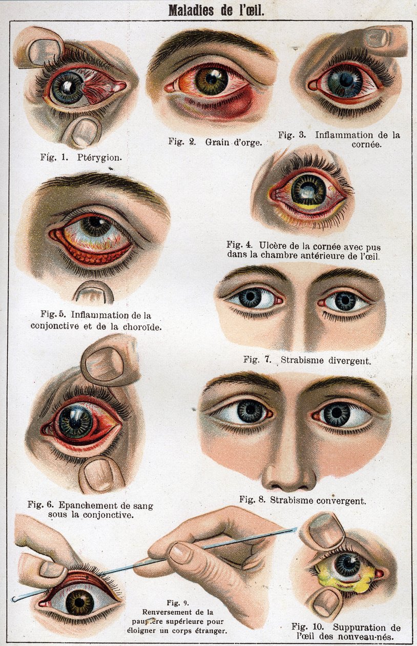 Nemoci oka. „Nová přírodní medicína“ od F.E. Bilze. od Unknown artist