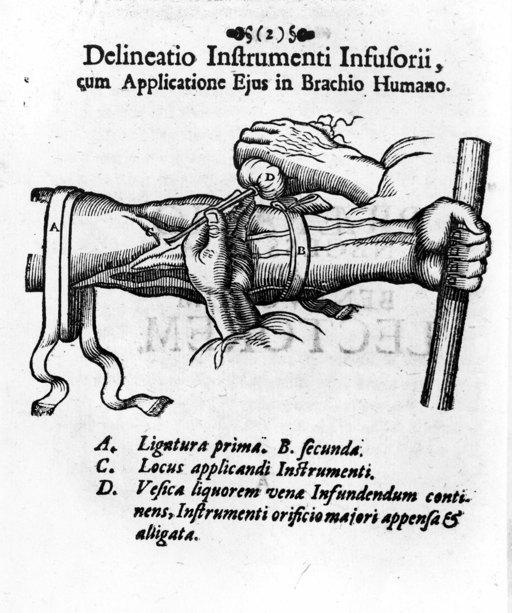 Intravenózní injekce pomocí klysterového močového měchýře. od J. D. Mayor, „“Surgery Infusoria“, Kilonii 1667 od Unknown artist