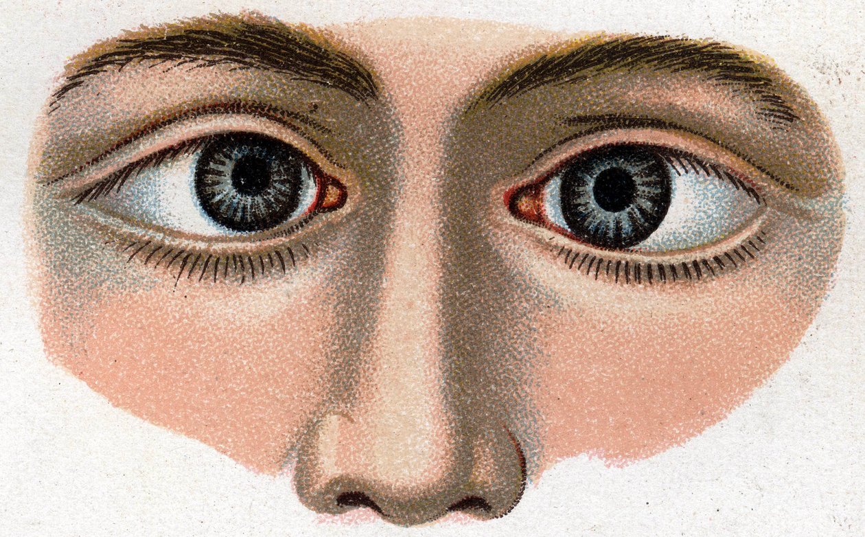 Strabismus konvergovat. „Nový přírodní lék“ od F.E. Bilze. od Unknown artist
