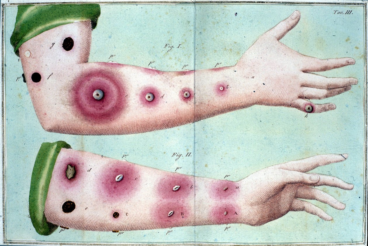 Příznaky onemocnění neštovic způsobující propuknutí pustul na kůži. Lékařská deska z "" Vaccination Treat" od Luigi Sacco, Milán od Unknown artist