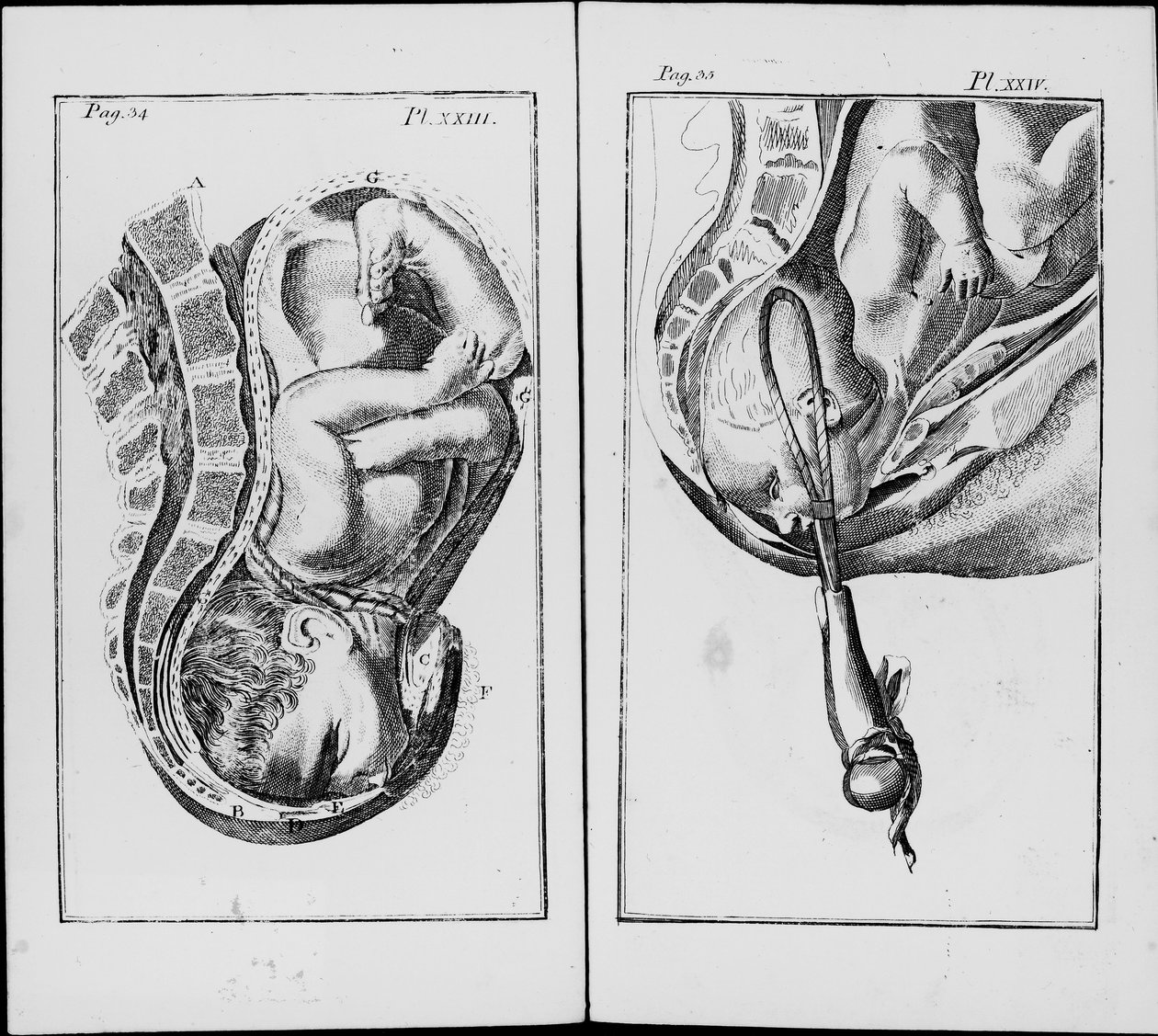 Narození dítěte pomocí kleští Talíř z „Zkrácení praxe porodní asistence“ od Williama Smellie (1697-1763) od Unknown artist