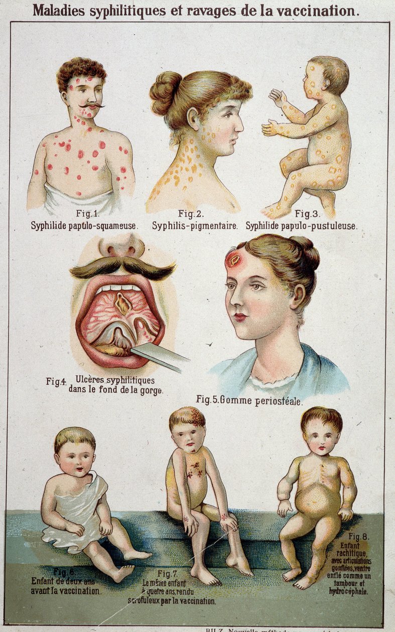 Deska ilustrující různé koleje syfilitických nemocí a nebezpečí očkování - v přírodní medicíně Bilz koncem 19. století. od Unknown artist