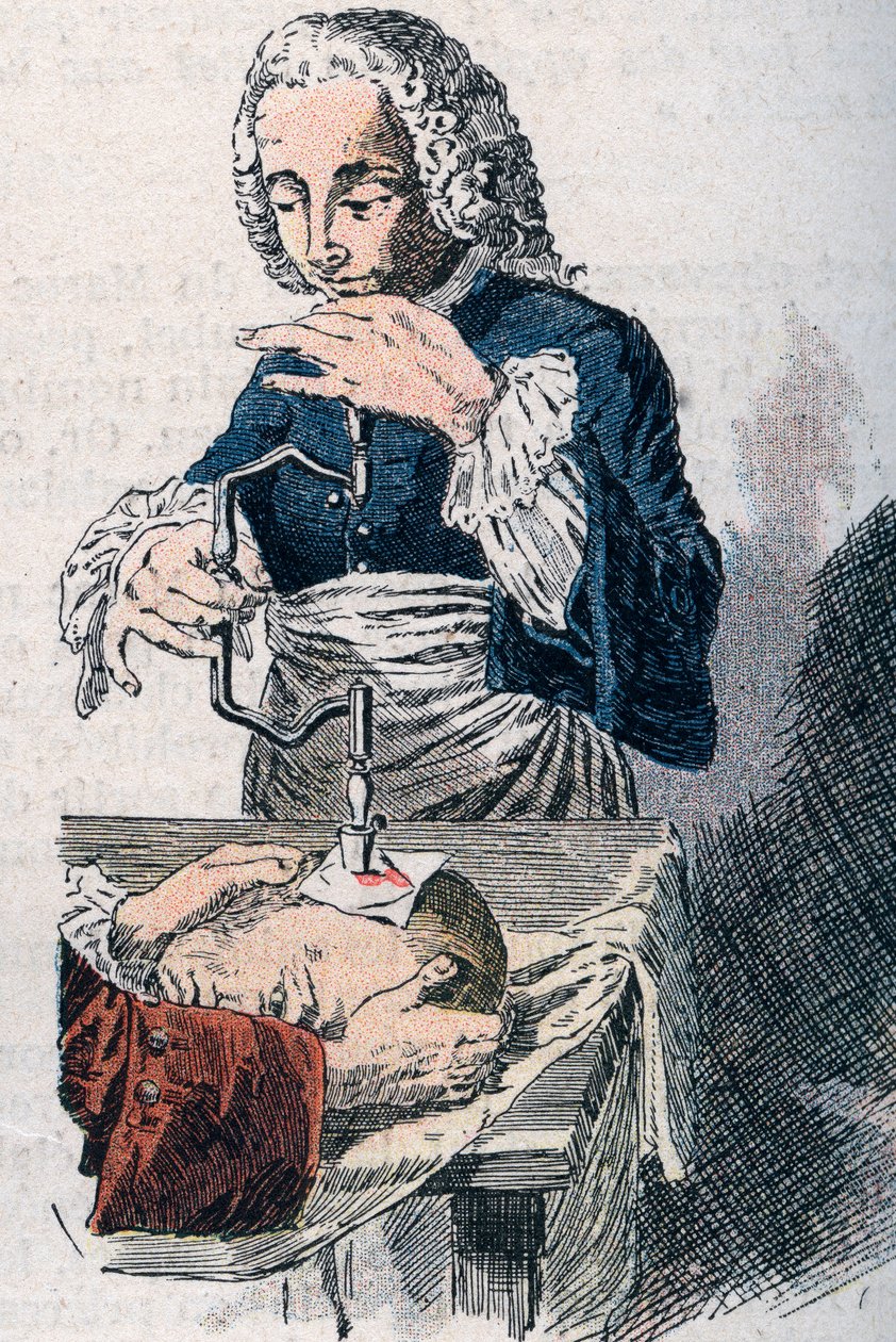 Trepanace. tisk z 18. století. od Unknown artist