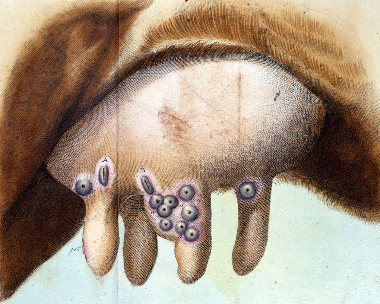 Luigi Sacco (1769-1836) v lednu 1801 použil kravský prs k naočkování vakcíny proti neštovicím. Medicínská deska z „“ Vaccination Treat“ od Luigi Sacco, Milán od Unknown artist