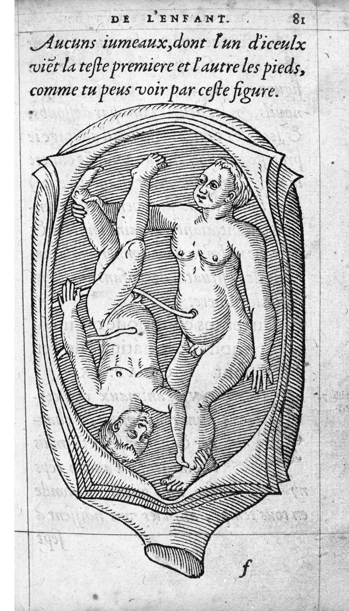 Poloha plodu v děloze během těhotenství. Rytina z „“De la generation des enfants““ od francouzského lékaře a chirurga Ambroise Pare (1509-1590) 16. století od Unknown artist