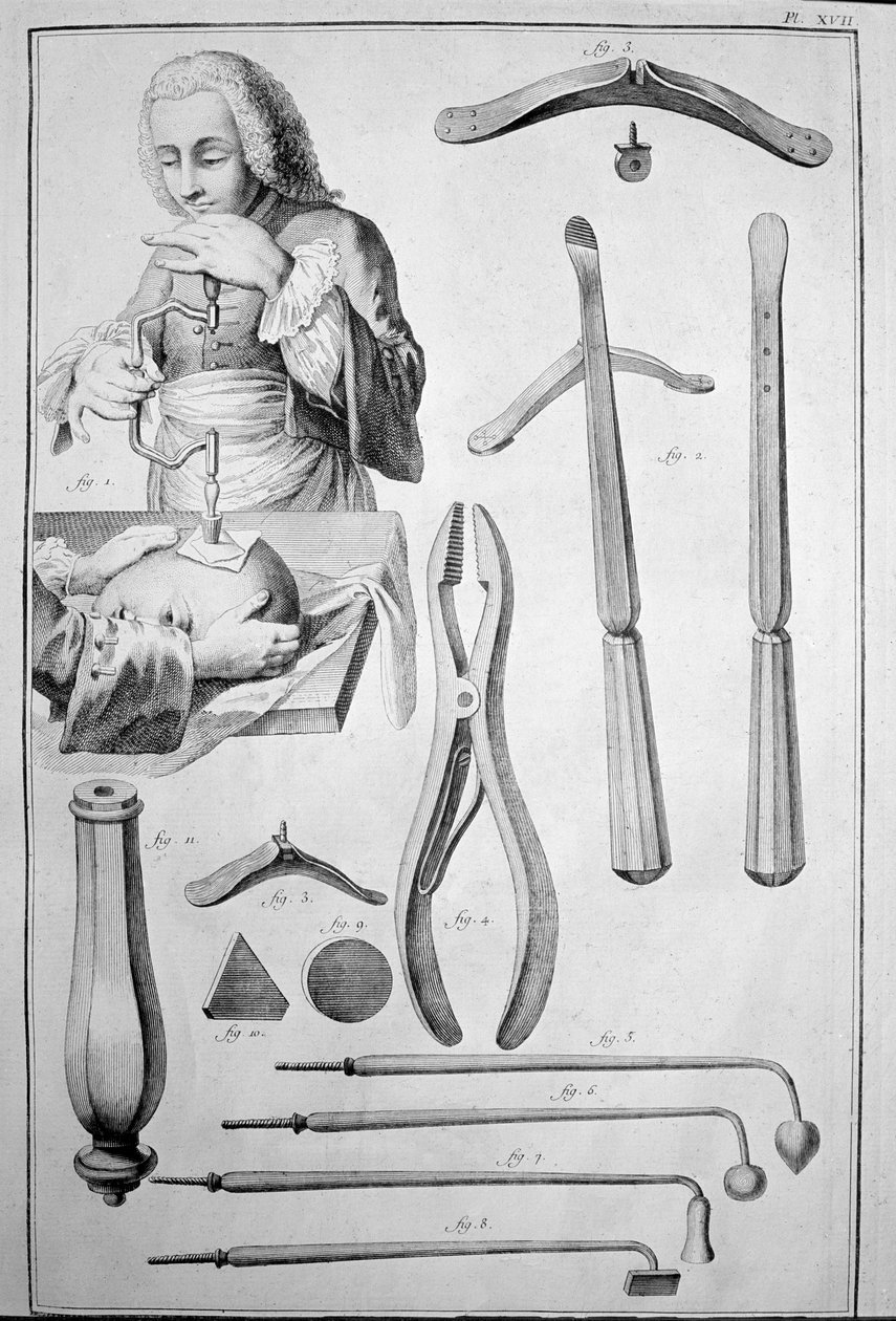 Trepanace lebky, různé nástroje (rytina od Unknown artist