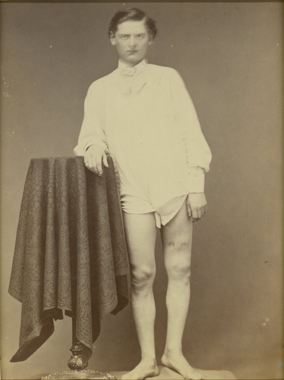 Zraněný voják z občanské války (voják Charles Westerfield, Army Medical Museum Exemmen No. 4278), duben 1865, 1865 (tisk alba) od William Abraham Bell