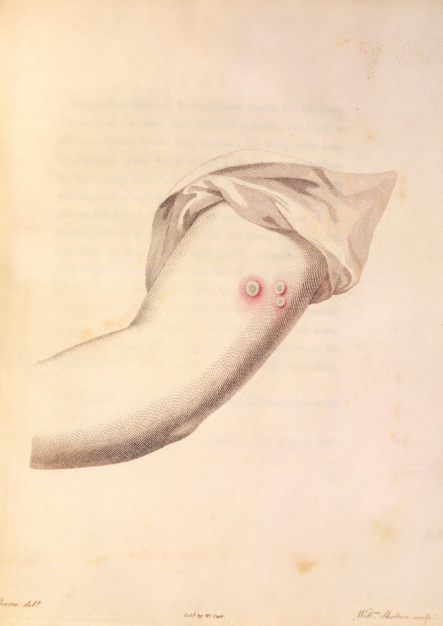 Rameno Williama Peada používané pro vakcínu proti neštovicím, z „An Inquiry into the Causes and Effects of Variolae Vaccinae“ od Edwarda Jennera (1748-1823), vyryto Pearcem, kolem roku 1800 od William Skelton