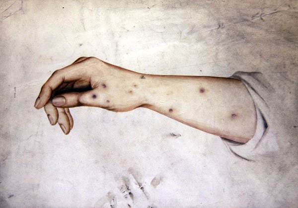 Studie předloktí se stavem kůže, asi 1850 (akvarel na papíře) od William Lover