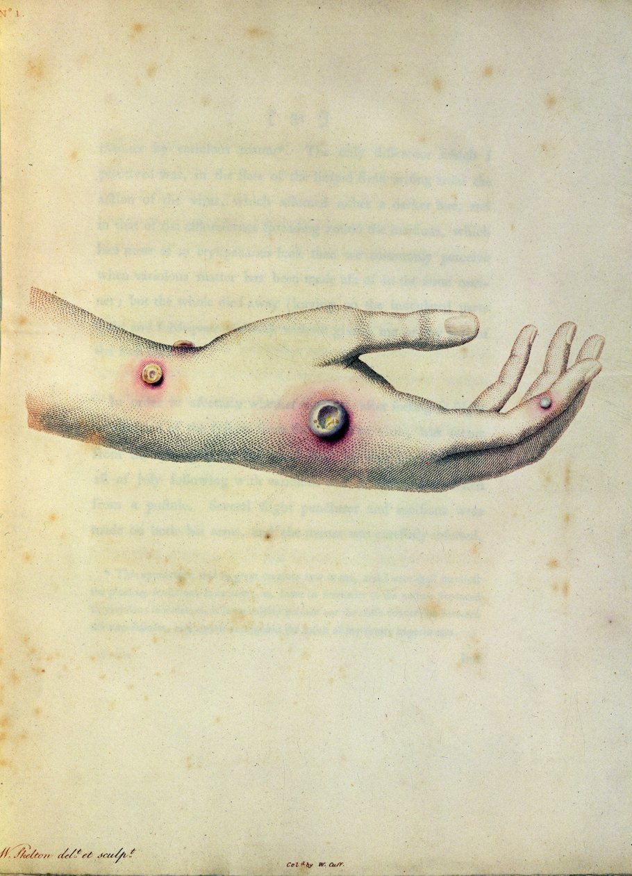 Puchlina kravských neštovic na paži Sarah Nelmes, z „An Inquiry to the Causes and Effects of Variolae Vaccinae“ od Edwarda Jennera (1749-1823), vyryto Pearcem, kolem roku 1800 od William Skelton