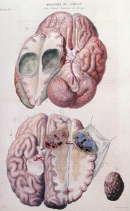 Rakovinné nádory mozku, z „Anatomie Pathologique du Corps Humain“ od Jean Cruveilhier (1791-1874) 1828-42 (barevná rytina)
